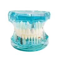 angzhili прозрачная модель для восстановления зубов для взрослых со съемным зубом - стандартный обучающий инструмент для стоматолога для студентов (1 шт.) логотип
