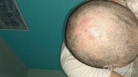 img 7 attached to Kleravitex Anti-Hair Loss Dropper: натуральная сыворотка для роста волос для истончения волос, лечения облысения и перхоти.