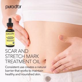 img 1 attached to 🌹 PURA D’OR Organic Scar and Stretch Mark Treatment Oil - USDA Certified - Rosehip, Wheat Germ, Argan, Tamanu, Carrot, Rosemary, Lavender, Geranium, Patchouli, Sage - Skin Care