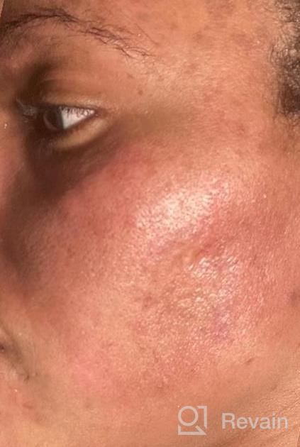 img 1 attached to 🔆 Ebanel Dark Spot Remover Cream for Face - Skin Brightening, Melasma, Hyperpigmentation and Sun Spot Treatment - Age Spot, Freckle Fade Cream with Synovea, 4-Butylresorcinol, Niacinamide, Glutathione review by Eric Carr