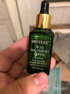 img 1 attached to 🌿 Clear Severe Acne with BREYLEE Tea Tree Clear Skin Serum – Pimple Remover & Skin Repair review by Matthew Carr