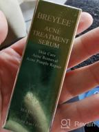 img 1 attached to Tea Tree Acne Treatment Serum For Clear Skin - 17Ml, 0.6Oz - Severe Breakout & Pimple Remover, Repairing review by Scott Larson