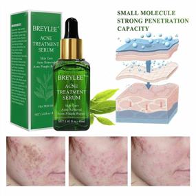 img 2 attached to BREYLEE Tea Tree Acne Treatment Serum For Clearing Severe Blemishes, Breakouts & Pimples - 40Ml (1.41Fl Oz) Cystic Acne Treatment Skin Clearance Products