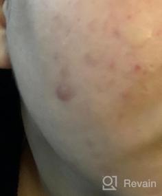 img 6 attached to Dermaflage Scar Filler & Concealer: Acne Scar & Scar Makeup, 1 Month Supply