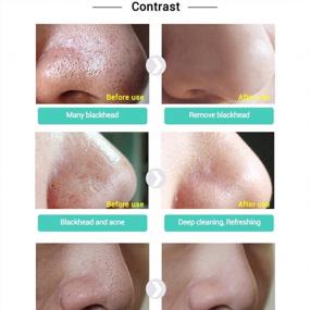 img 2 attached to Get Clear And Radiant Skin With Ofanyia'S Deep Cleansing Nose Blackhead Remover Mask - Acne Treatment And Pore Strips
