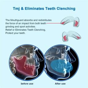 img 1 attached to Крупный размер регулируемой и обрезаемой защитной щитовидки от скрежета зубов - пакет из 4 профессиональных щитовидок для взрослых. Прекращает бруксизм, зубную гигиену и спортивную активность, ночную защиту.