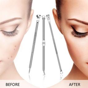 img 3 attached to 🔴 Premium Dual-Head Blackhead Remover Kit: 6PCS Stainless Steel Set, Pimple Comedone Extractor, Acne Whitehead Blemish Removal Tool with Portable Box - Safe for Face Skin