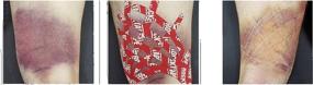 img 1 attached to RockTape Kinesiology Tape - Recovery Edema Patches for Bruising, Pain Relief, Muscle Injuries - 20 Pre-Cut Strips