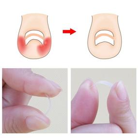 img 1 attached to Correct and Straighten Ingrown Toenails with Ingrown Toenail Corrector Strips: 10pcs Bottle of Straightener Clips Curved BS Brace for Thick Nail Correction - Foot Tool