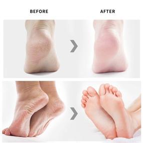 img 1 attached to YOUPINWEI Foot Peel Mask - Dry Cracked Feet Peel, Callus & Dead Skin Remover - Exfoliating Foot Mask, Baby Soft Feet - 2 Pairs/Box