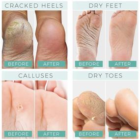 img 2 attached to 👣 Foot Peel Mask: Say Goodbye to Cracked Heels and Calluses - Get Baby Soft Feet with this Exfoliating Peeling Natural Treatment! (2 Pack, Women's 5-11)