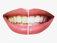 💎 ultra thin teeth veneers: 100 pcs for whitening & resin anterior upper temporary c-rown! logo