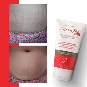 img 1 attached to 🤰 Cicatrissm Stretch Mark Remover Cream - Pregnancy and Postpartum Tummy Care - Belly Butter for Reducing Red and Purple Stretch Marks - Effective Skin Treatment to Fade and Remove Marks