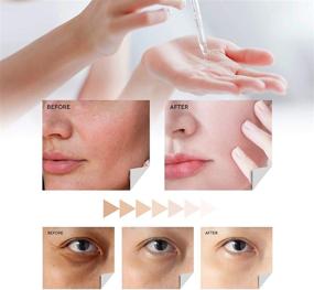 img 3 attached to 🌟 Ultimate Skin Discoloration Treatment: Kojic Acid Serum with Arbutin for Face and Body - Natural & Gentle Solution for All Skin Types!