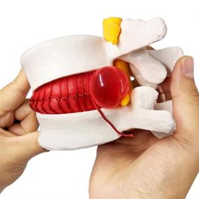 img 4 attached to Herniated Anatomical Vertebrae Prolapse Education