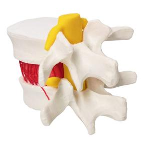 img 1 attached to Herniated Anatomical Vertebrae Prolapse Education