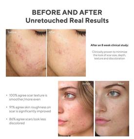 img 2 attached to Murad InvisiScar Resurfacing Treatment - Effective Solution for Acne Scars & Dark Spots, 1 Fl Oz, Larger Size