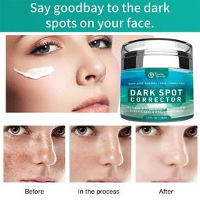 img 3 attached to Face Dark Spot Remover: Melasma, Freckle, Hyperpigmentation 💆 Treatment Cream for Men and Women - Sun Spot Corrector