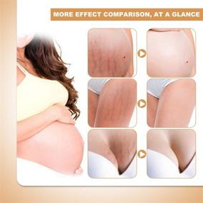 img 1 attached to 🤰 Advanced Stretch Mark Cream for Pregnancy and Postpartum: Effective Scar Repair and Removal