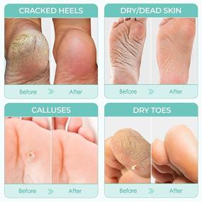 img 2 attached to Foot Peel Mask - Large Size: Repair Cracked Heels, Remove Dead Skin & Calluses, Get Baby Soft Feet & Smooth Skin - Exfoliating Peeling Natural Treatment (2 Pack)