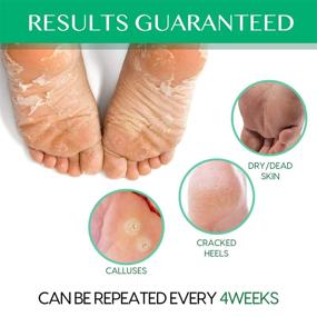 img 2 attached to 🦶 MEEYEE Foot Peel Mask, 3 Pack - Remove Callus, Cracked Heels & Dead Skin, Soften Dry Feet, Pain-Free Exfoliating Mask with Aloe Vera & Olive Oil