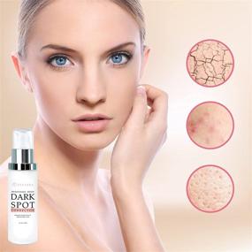 img 2 attached to Dark Spot Remover Corrector Hyperpigmentation