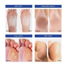 img 3 attached to Aliceva Foot Peel Mask - Advanced Exfoliating Treatment, Callus and Dead Skin Remover - 2 Pairs