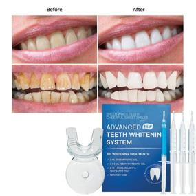 img 2 attached to AngelicMisto Teeth Whitening Kit: 5 Min Non-Sensitive Fast Teeth Whitener with 35% Carbamide Peroxide Gel - Remove Stains from Coffee, Smoking, Wine, Soda, Food!