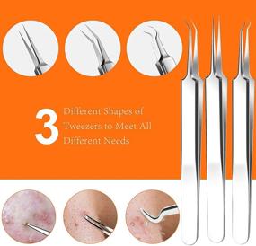 img 1 attached to 15-Piece Blackhead Remover Tools Set, Pimple Popper Kit, Acne Extractor Tool, Professional Stainless Steel Pimple Acne Blemish Removal Set with Metal Case – Latest 2021