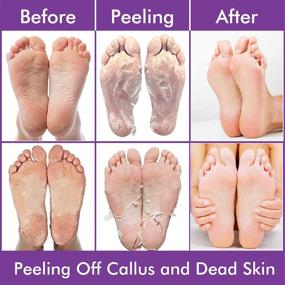 img 2 attached to 👣 2021 Newest & Effective Foot Peel Mask - 5 Pack for Callus and Dry Dead Skin, Dry Cracked Feet, Feet Peeling Mask With Lavender and Aloe Vera Gel for Men and Women