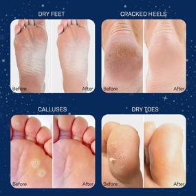 img 1 attached to Get Soft Feet in 1-2 Weeks! - 2 Pairs of Foot Peel Mask for Cracked Heels, Dead Skin, and Calluses