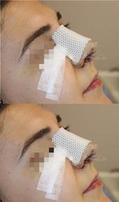 img 3 attached to Thermoplastic Rhinoplasty Septoplasty Orthopedic Immobilization