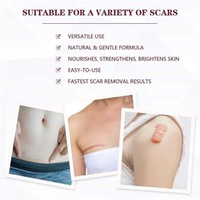 img 3 attached to Advanced Scar Removal Cream: Erase Stretch Marks, Old Scars, and Acne Effectively! Non-Greasy & Non-Irritating for Pregnancy Scars & Stretch Marks