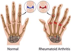 img 1 attached to Jaxbo Arthritis Compression Fingerless Stiffness