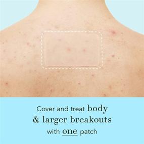 img 3 attached to 🌟 Clear & Powerful Acne Solution: Rael Miracle Patches XL Cover for Face and Body - Hydrocolloid Spot Control Treatment, Targeting Large Acne Clusters (6 Patches)