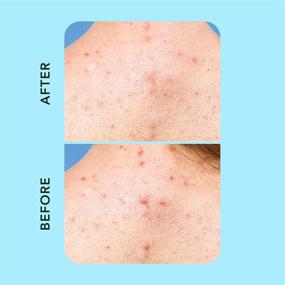img 2 attached to 🌟 Clear & Powerful Acne Solution: Rael Miracle Patches XL Cover for Face and Body - Hydrocolloid Spot Control Treatment, Targeting Large Acne Clusters (6 Patches)