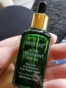 img 7 attached to Tea Tree Acne Treatment Serum For Clear Skin - 17Ml, 0.6Oz - Severe Breakout & Pimple Remover, Repairing