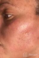 картинка 1 прикреплена к отзыву 🔆 Ebanel Dark Spot Remover Cream for Face - Skin Brightening, Melasma, Hyperpigmentation and Sun Spot Treatment - Age Spot, Freckle Fade Cream with Synovea, 4-Butylresorcinol, Niacinamide, Glutathione от Brad Collins