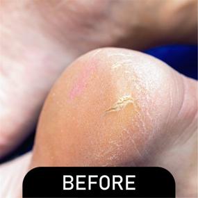 img 2 attached to 🩺 Pedi-Live Pro 0-Minute Callus Eliminator