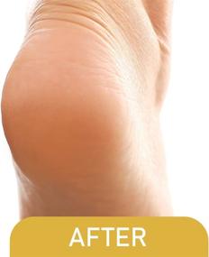 img 1 attached to 🩺 Pedi-Live Pro 0-Minute Callus Eliminator