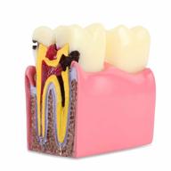 dental caries tooth model: 6x decay teeth comparative study for dentist, patient education & explanation logo