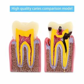 img 3 attached to Dental Caries Tooth Model: 6X Decay Teeth Comparative Study For Dentist, Patient Education & Explanation