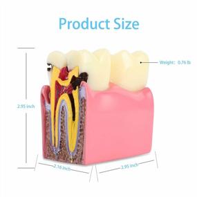 img 2 attached to Dental Caries Tooth Model: 6X Decay Teeth Comparative Study For Dentist, Patient Education & Explanation